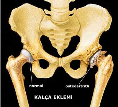 Kalça Protezi