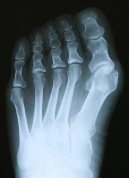 Halluks Valgus — görsel 2
