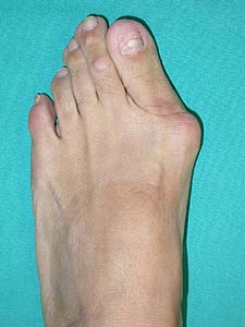 Halluks Valgus