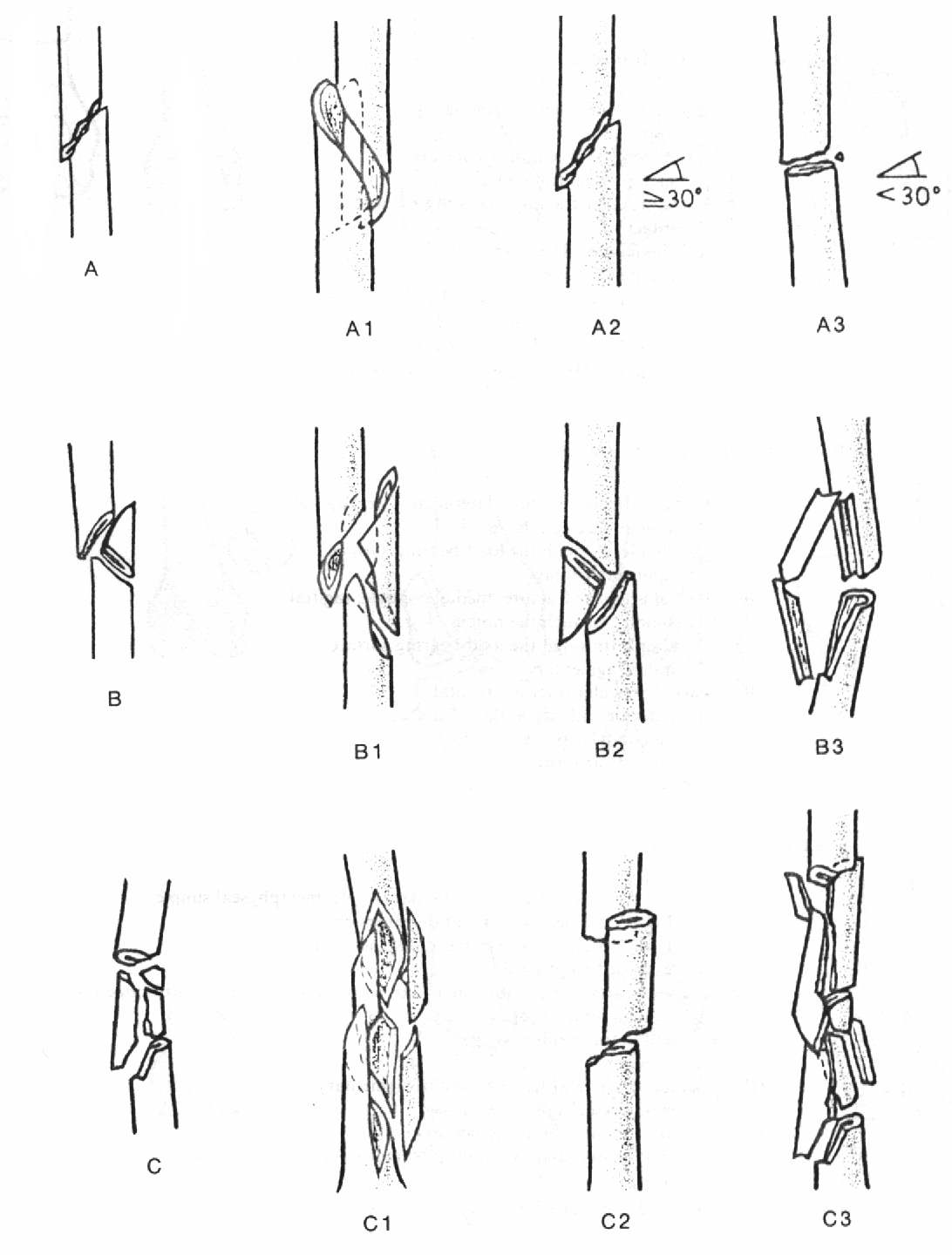 Femur Kırıkları — görsel 2