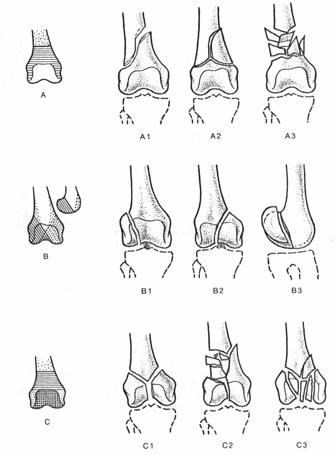 Femur Kırıkları — görsel 3