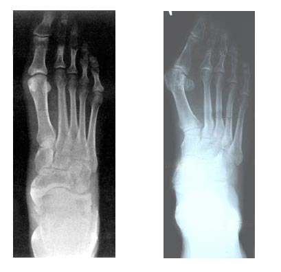 Halluks Valgus — görsel 1